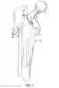 Fig. 08 - Femoral stem and post system for hip prosthesis