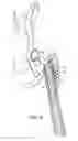 Fig. 09 - Femoral stem and post system for hip prosthesis