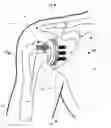 Fig. 01 - IMPLANTABLE PROSTHESES