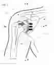 Fig. 05 - IMPLANTABLE PROSTHESES