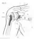 Fig. 11 - IMPLANTABLE PROSTHESES