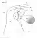 Fig. 18 - IMPLANTABLE PROSTHESES