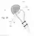Fig. 22 - IMPLANTABLE PROSTHESES