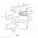 Fig. 07 - Spinal implant system and method