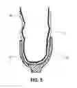Fig. 06 - PROSTHESIS COOLING LINER SYSTEM