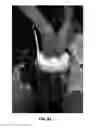 Fig. 18 - PROSTHESIS COOLING LINER SYSTEM