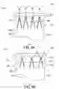 Fig. 04 - Low profile stent and delivery system