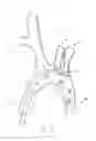 Fig. 11 - Frame structures, stent grafts incorporating the same, and methods for extended aortic repair