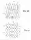 Fig. 03 - STENT AND PROCESS FOR PRODUCING SAME