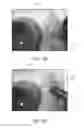 Fig. 08 - CANNULA INSERTION SUSTAINING SYSTEMS AND DEVICES