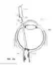 Fig. 04 - Optic Nerve Implants