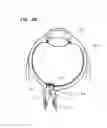 Fig. 05 - Optic Nerve Implants