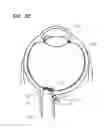 Fig. 06 - Optic Nerve Implants