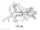Fig. 06 - AURAL FOREIGN BODY REMOVAL DEVICE AND RELATED METHODS OF USE AND MANUFACTURE