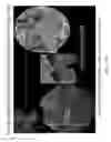 Fig. 14 - Activated micro-bubble based root canal disinfection