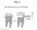 Fig. 04 - ORAL CARE COMPOSITIONS FOR TREATMENT OF SENSITIVE TEETH