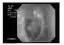 Fig. 01 - Agent for regenerating tympanic membrane or external auditory canal