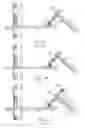 Fig. 10 - TRANSCUTANEOUS DEVICE FOR REMOVAL OF FLUID FROM A BODY