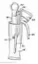 Fig. 01 - Compact catheter assembly with adjustable catheter tube