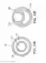 Fig. 06 - Balloon catheter