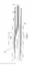 Fig. 03 - Balloon catheter