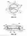 Fig. 03 - Methods and devices for locating and adjusting an implantable valve