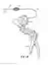 Fig. 03 - Clearance of sinus ostia blockage