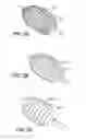 Fig. 04 - Clearance of sinus ostia blockage