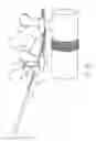 Fig. 08 - Systems and methods for implanting electrode leads for use with implantable neuromuscular electrical stimulator
