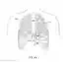Fig. 05 - Cardiac pacing lead delivery system