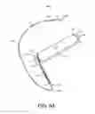 Fig. 12 - Cardiac pacing lead delivery system