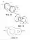 Fig. 19 - Delivery system for cardiac pacing