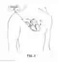 Fig. 04 - Far-field R-wave detection to control atrial pace timing in a dual-chamber leadless pacemaker