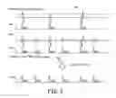 Fig. 07 - Far-field R-wave detection to control atrial pace timing in a dual-chamber leadless pacemaker