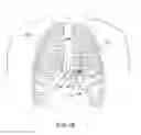 Fig. 06 - Cardiac pacing