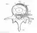 Fig. 02 - System and methods for diagnosis and treatment of discogenic lower back pain