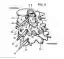 Fig. 04 - System and methods for diagnosis and treatment of discogenic lower back pain