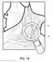 Fig. 02 - Closed-loop vagus nerve stimulation
