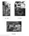 Fig. 17 - TRANSCRANIAL MAGNETIC STIMULATION FOR IMPROVED ANALGESIA