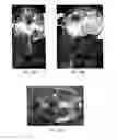 Fig. 19 - TRANSCRANIAL MAGNETIC STIMULATION FOR IMPROVED ANALGESIA