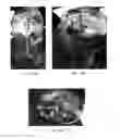 Fig. 20 - TRANSCRANIAL MAGNETIC STIMULATION FOR IMPROVED ANALGESIA