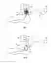 Fig. 02 - METHODS AND DEVICES FOR TREATING MIGRAINES WITH ELECTROMAGNETIC STIMULATION