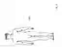 Fig. 32 - METHODS AND DEVICES FOR TREATING MIGRAINES WITH ELECTROMAGNETIC STIMULATION