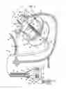 Fig. 02 - Reverse loop ablation device