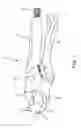 Fig. 02 - Perforation apparatus for cable jackets and related systems and methods