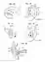 Fig. 12 - Moldable Earpiece System