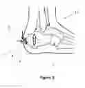 Fig. 02 - STRAIN-RELIEF ELEMENT FOR FOOTWEAR ARTICLES