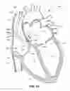 Fig. 12 - Systems and methods to determine HR, RR, and classify cardiac rhythms based on atrial IEGM and atrial pressure signals