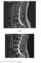 Fig. 02 - Measure of disc degeneration and pathology