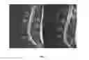 Fig. 06 - Measure of disc degeneration and pathology